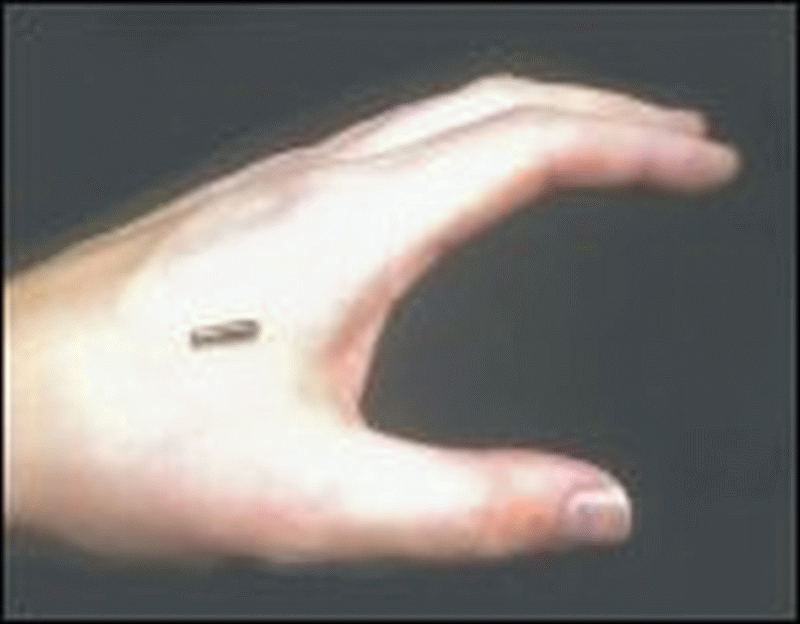 RFID chip on hand. Once implanted, can be read by any RFID scanner.